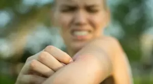 7 причини комарите да ни хапят по-често от другите